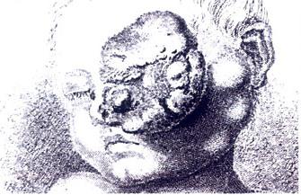 Drawing of a large retinoblastoma