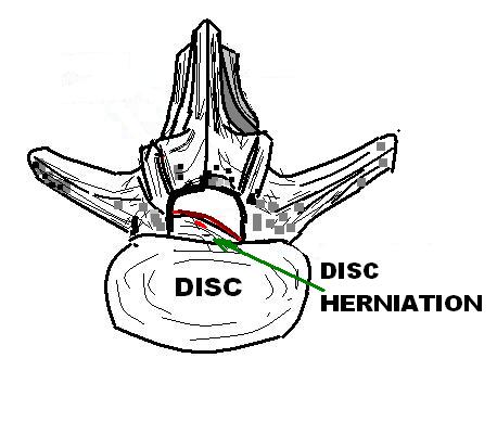 LUMBAR_DISC_HERNIATION