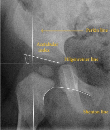 Normal hip.[3]