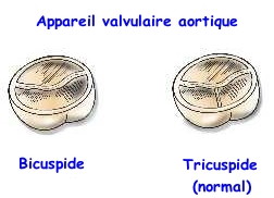 Description de l'image valves-aortiques.jpg.