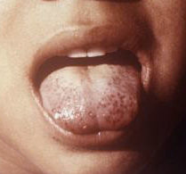 A child presenting a "scorbutic tongue" due to vitamin C deficiency