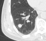 Round well-delineated solid lung nodule with smooth border.[9]