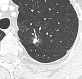 Nodule with pleural retraction.[9]