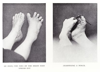 Left: toes adducted (pulled towards the center) and spread (abducted); right, both feet clenched (plantar flexed)