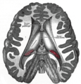 Disección que muestra los ventrículos del cerebro.