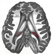 Dissecção mostrando os ventrículos cerebrais.