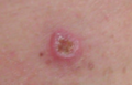 Melanoma, right posterior thigh