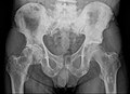 Radio du bassin d'un patient atteint d'un carcinome de la prostate : multiples métastases ostéocondensantes, en particulier sur le sacrum, mais aussi sur l'ilion surtout gauche (à dr. sur l'image), sur la pointe de l'ischion gauche, et sur le fémur proximal gauche. On détecte à l'occasion une arthrose de hanche droite (à g. sur l'image).