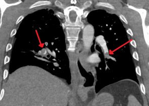 Сегментна и субсегментна плућна емболија са обе стране