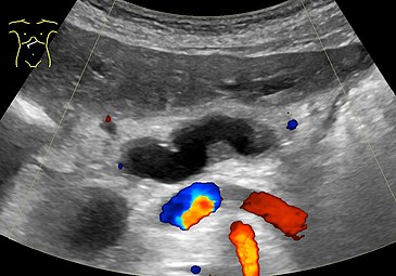 Image of the dilated pancreatic duct in the body of the pancreas. It is colorless (black) in contrast to blood vessels (splenic vein closest below, and superior mesenteric artery at bottom)) which have Doppler signal.