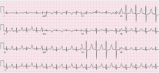 ECG of a 47-year-old male with hypocalcemia and calcium level = 5.3 mg/dL