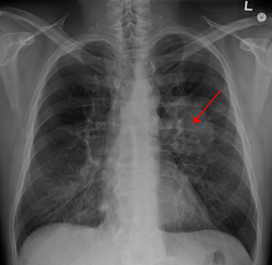 تصوير الصدر بالأشعة السينية يُظهر السهم الأحمر ورمًا في الرئة اليُسرى