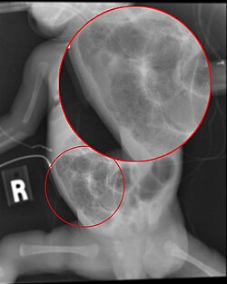 تصوير شعاعي of a baby with necrotizing enterocolitis