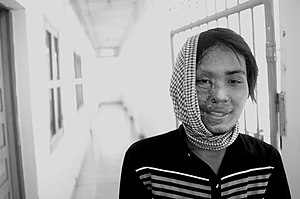 Portrait of a female acid attack victim showing facial injuries
