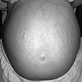 Striae gravidarum in a pregnant woman at 38 weeks