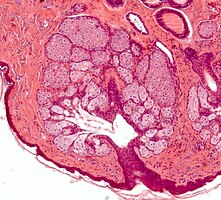 Multiples glandes sébacés s'abouchant à un follicule pileux.