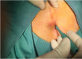 Trephine/biopsy punch minimally invasive surgery for pilonidal disease (1)