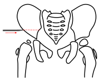 Salter-Osteotomie rechts. Schritt 1 – Osteotomie des Os ilium