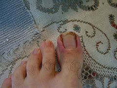 Toenail that became ingrown at the ends months after a soccer injury to the nail