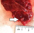 Gross pathology of a parathyroid gland (white arrow), next to the thyroid gland