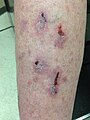 Lichen planus über dem Schienbein, hier mit Ulzerationen