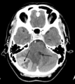 A tumor of the posterior fossa leading to mass effect and shift of the fourth ventricle