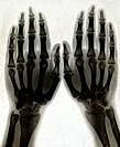 X-ray of Norah Schuster's hands