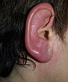 Erysipelas (ear)