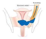 Cervical cancer stage IIIB