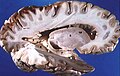 Human brain right dissected lateral view