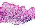 Micrograph of vulvar intraepithelial neoplasia III. H&E stain.