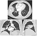 CT scan of the same case.