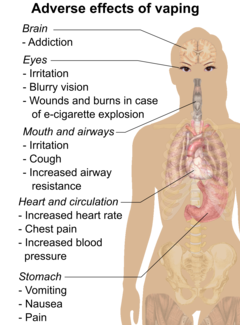 Serious adverse effects of vaping include corneoscleral lacerations or ocular burns or death after e-cigarette explosion. Less serious adverse effects of vaping include eye irritation, blurry vision, dizziness, headache, throat irritation, coughing, increased airway resistance, chest pain, increased blood pressure, increased heart rate, nausea, vomiting, and abdominal pain.