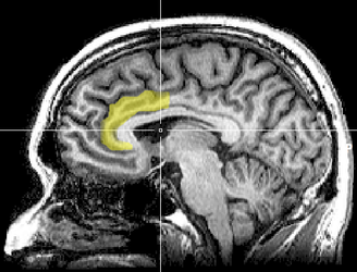 הדמיית MRI של פיתול החגורה הקדמי (ACC, בצהוב), המקום המשוער ממנו מגיעה הפעילות החשמלית היוצרת את ה-FRN.