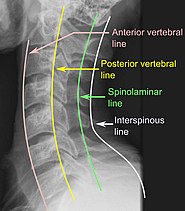 X-ray of normal congruous vertebral lines