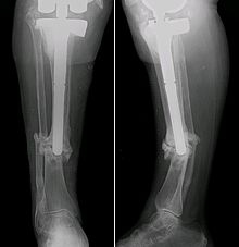 Pseudarthrosis Tibia jmn