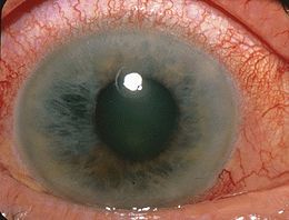 Description de l'image Acute Angle Closure-glaucoma.jpg.