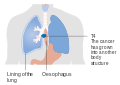 Stage T4 esophageal cancer