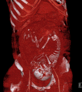 CT scan of a pregnancy, by Mikael Häggström