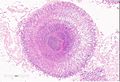 Aspergillosis.　無数の菌糸が集合しsunburst様の像を示す。