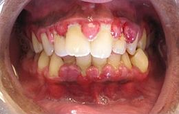 Description de l'image Gingivitis (crop).jpg.