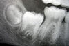 Radiograph of molars in different stages of development