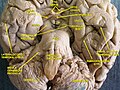 Cerebrum.Inferior view.Deep dissection.