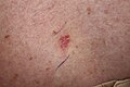 Superficial basal cell carcinoma. Public Domain