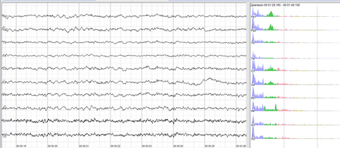 Human EEG with in resting state. Left: EEG traces (horizontal – time in seconds; vertical – amplitudes, scale 100 μV). Right: power spectra of shown signals (vertical lines – 10 and 20 Hz, scale is linear). 80–90% of people have prominent sinusoidal-like waves with frequencies in 8–12 Hz range – alpha rhythm. Others (like this) lack this type of activity.