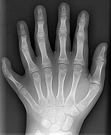 An X-ray of a polydactyl human left hand.