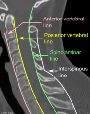 CT scan of normal congruous vertebral lines.[7]