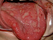 Erythema multiforme of tongue
