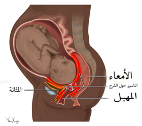 الأماكن الأكثر شيوعاً لحدوث ناسور الولادة.