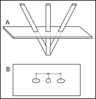 Figure 3. Depiction of the Sturm-Pastyr localizer and its intersection with the tomographic image plane. (A) Side view of the Sturm-Pastyr localizer. The tomographic image plane intersects two diagonal rods and one vertical rod. (B) Tomographic image. The intersection of the tomographic image plane with the Sturm-Pastyr localizer creates two fiducial ellipses and one fiducial circle. The relative spacing between the circle and the two ellipses varies with the height at which the tomographic image plane intersects the vertical rod.